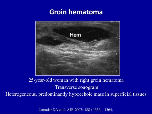 Ultrasound of the abdominal wall hernias