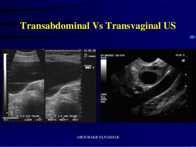 What Is an Ectopic Pregnancy recommendations What Is an Ectopic Pregnancy recommend