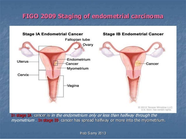Cervical most cancers smell cervical cancer resulting from virus