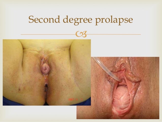 prolaps af uterus efter fødslen aalborg biografer prolaps af uterus efter fødslen aalborg biografer
