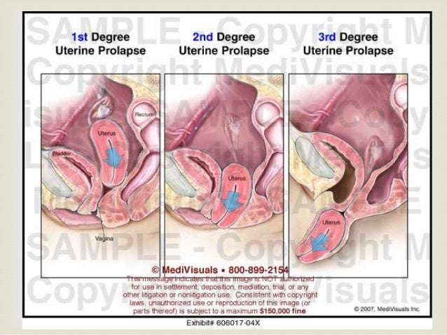 Cervical Protrusion remedy