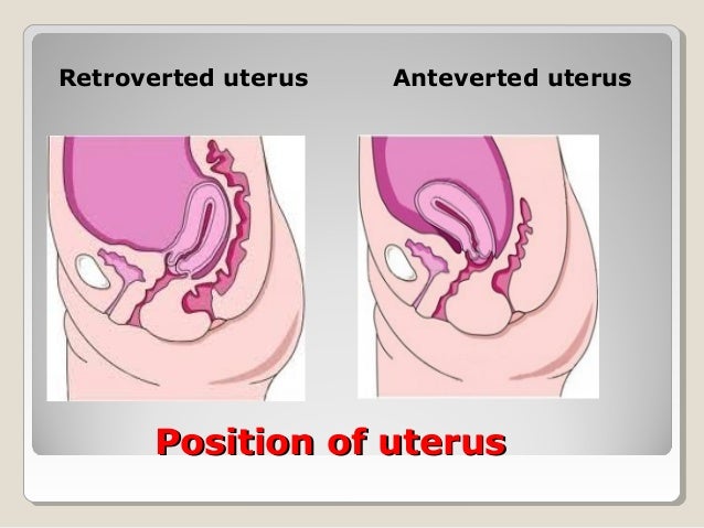 Utero Vaginal Prolapse