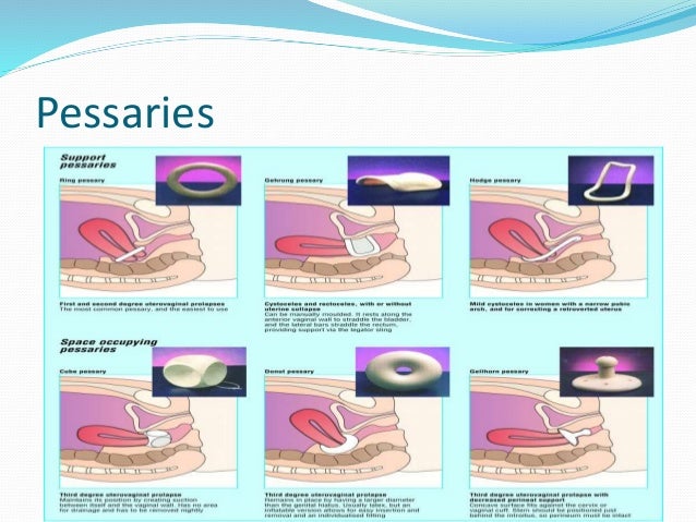 Cervical most cancers Cysts signs and symptoms