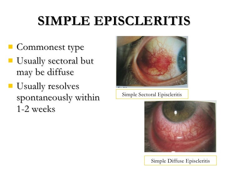 scleritis-driverlayer-search-engine