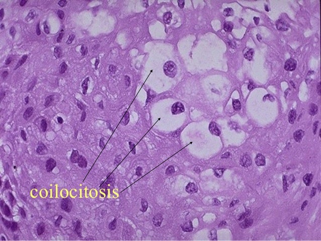 Most cancers Cervical En Espanol