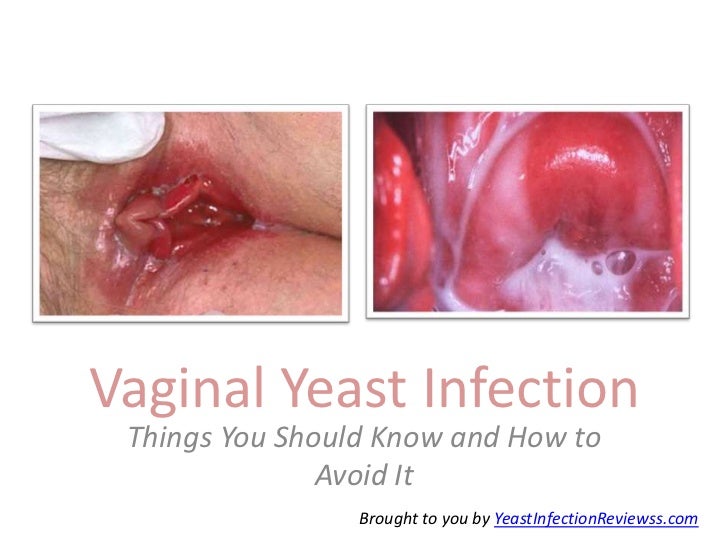 how to cure fungal infection