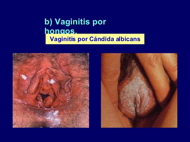 Recurrent vulvovaginal candidiasis - ScienceDirect