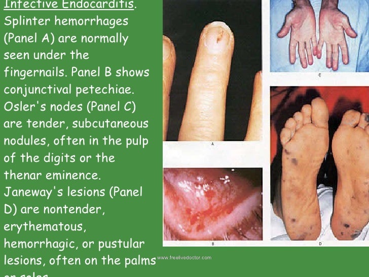 Valvular heart disease