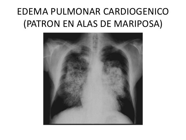 Valvulopatias Cardiacas