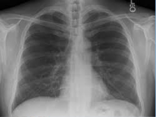 Can someone do my essay hospital-acquired pneumonia prevention