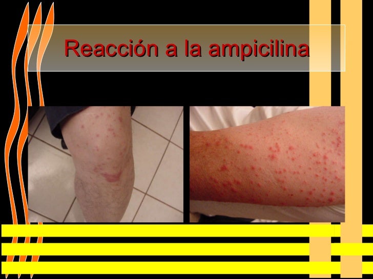 Que hacer si sobre la persona los granos y el picor