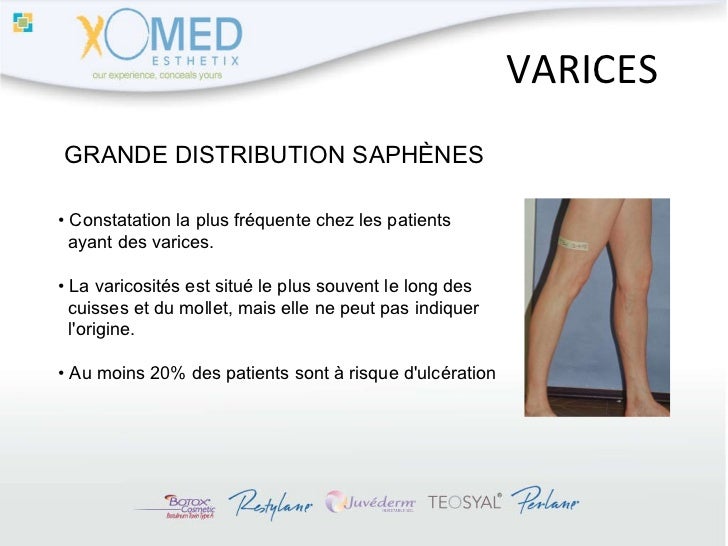 Comme lier la bande élastique à la varicosité