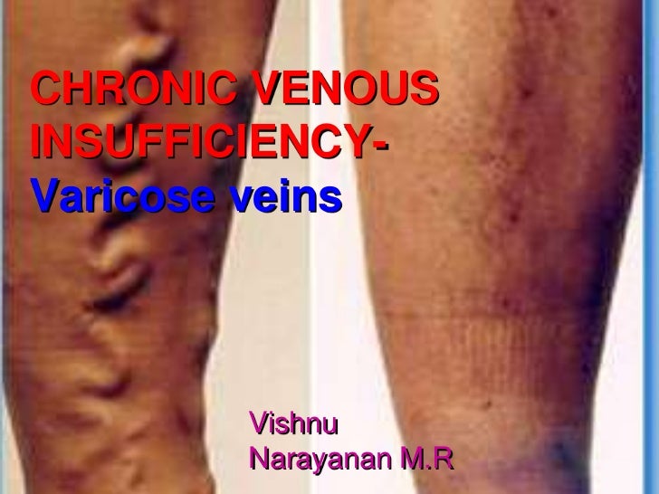 Varicose veins