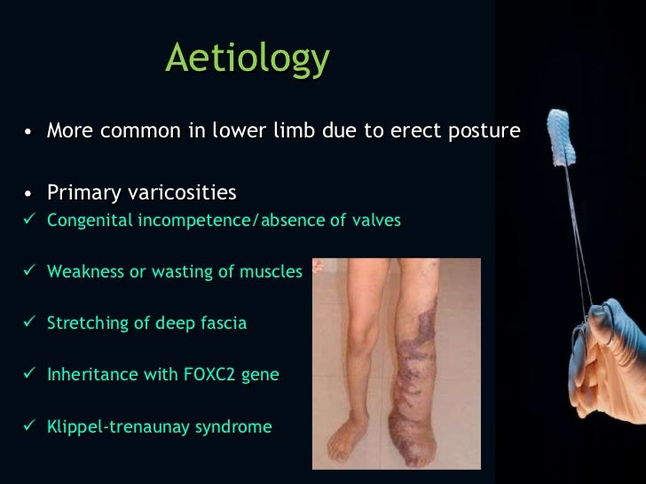 Varicose veins