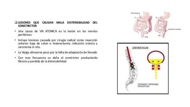 Vejiga neurogenica Vejiga neurogenica