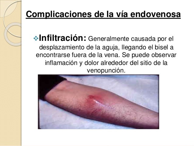 El uso del vinagre de manzana a varikoze