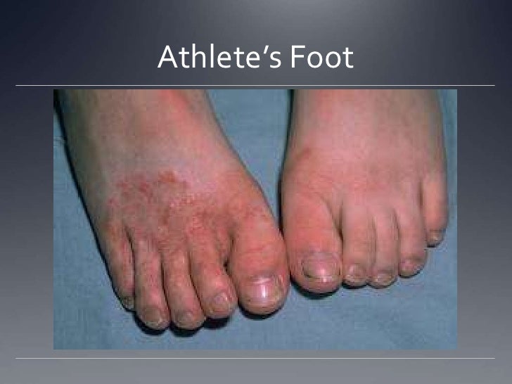 athletes foot slides