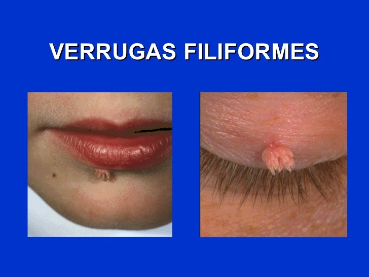 Podofilina Verrugas Related Keywords & Suggestions