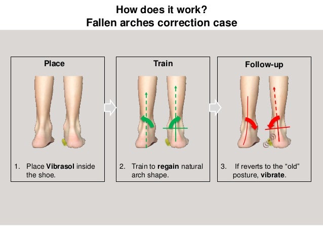 Adult Acquired Flat Feet