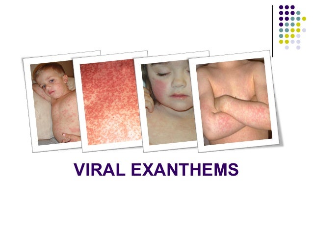 Virus that causes rash in adults