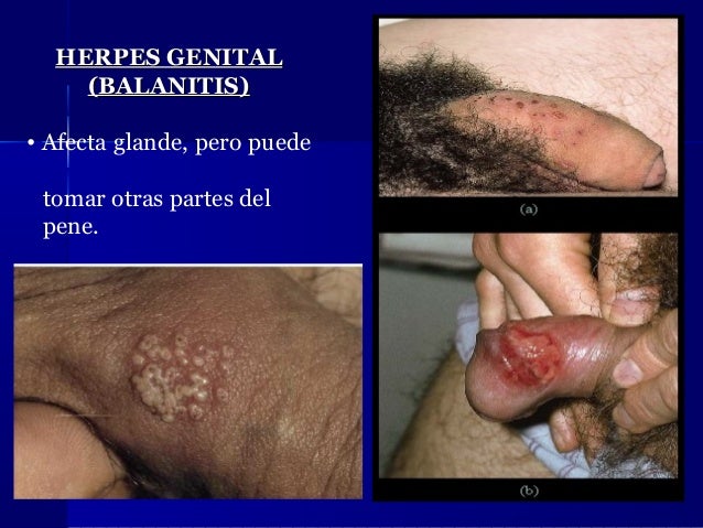 Behterev y la psoriasis