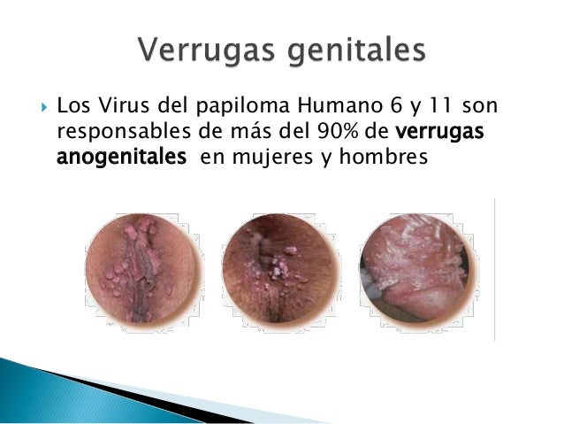 virus del papiloma humano vph 17 638