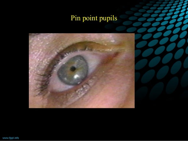 pinpoint eyes pinpoint eyes