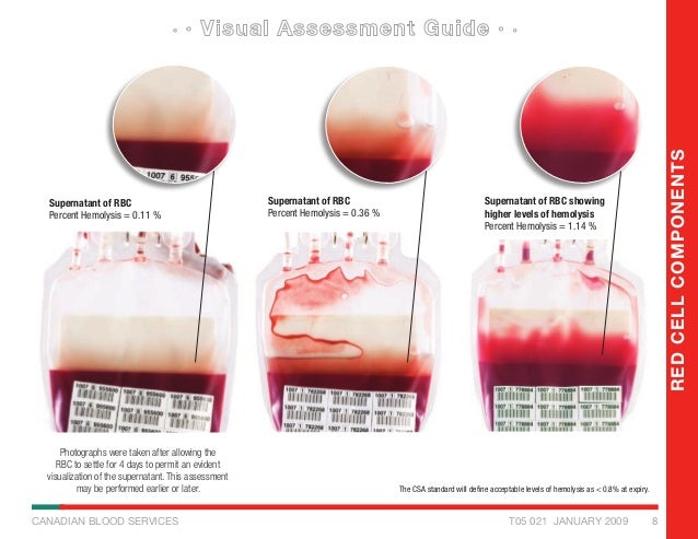 Visual Inspection Guide For Blood Compopnents Visual Inspection Guide For Blood Compopnents
