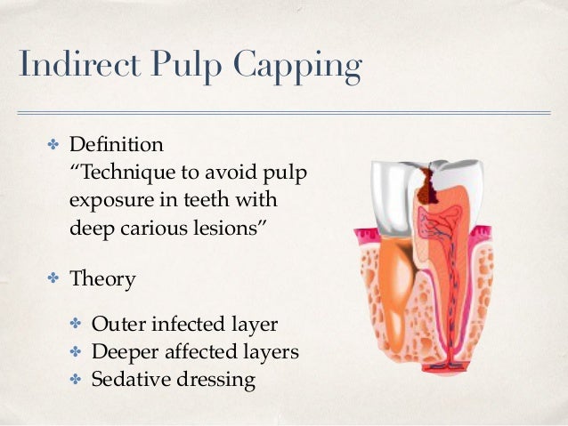 vital pulp therapy direct pulp capping