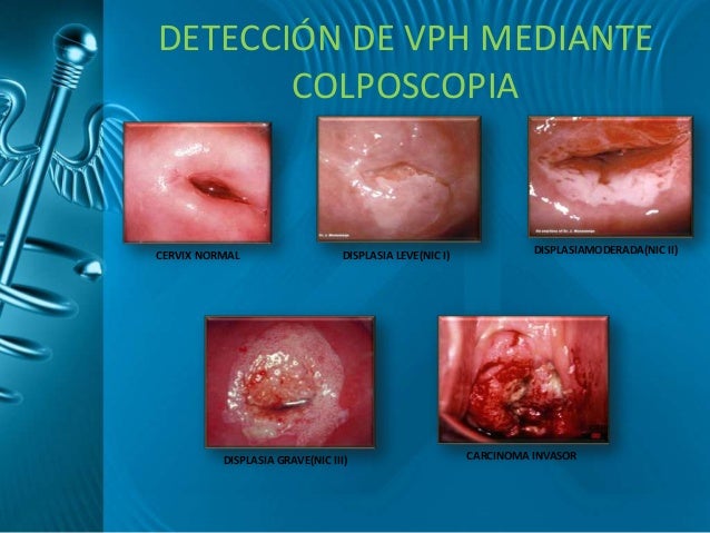 Fotos papiloma humano verrugas genitales 64 Fotos papiloma humano verrugas genitales 93