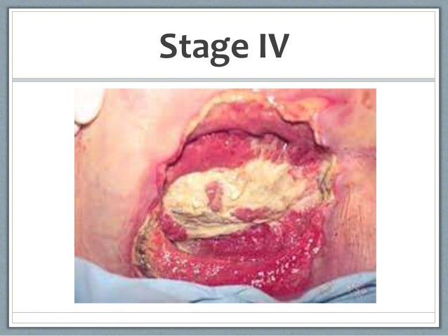 Related Keywords &amp; Suggestions for stage 4 ulcer