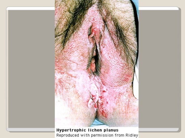 Lichen Simplex Chronicus - Symptoms, Diagnosis, Treatment ...