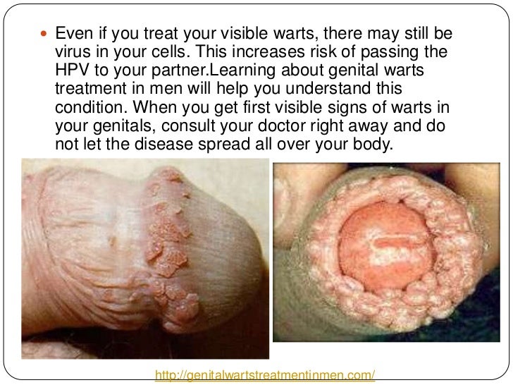 Can you get genital warts through masturbation Can you get genital warts through masturbation