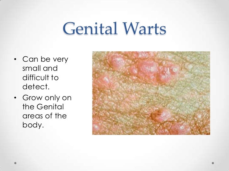 Warts Warts