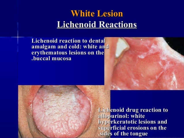 White Oral Lesion 50