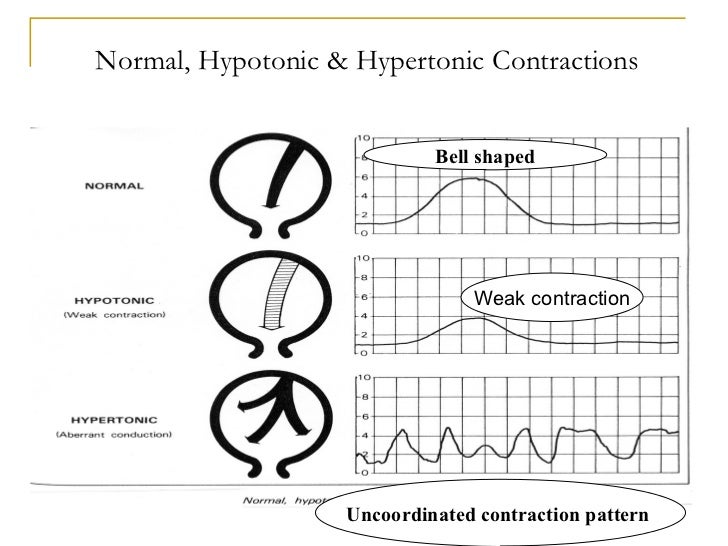 Wiki.assessment of uterine contractions 2011