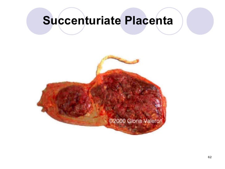 Wiki.placental abnormalities1
