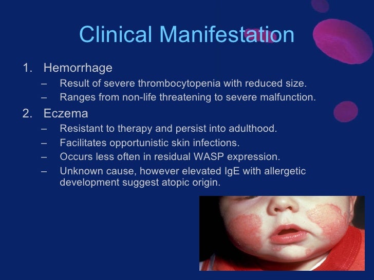 Dermatologic Manifestations of WiskottAldrich Syndrome