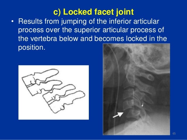 X-ray spine diagram of vertebral fracture 