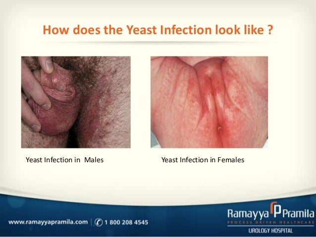 BEWARE GROSS PICTURES : Yeast Infection