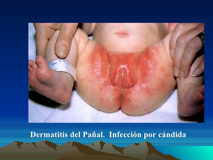 El cuarto de baño para la psoriasis