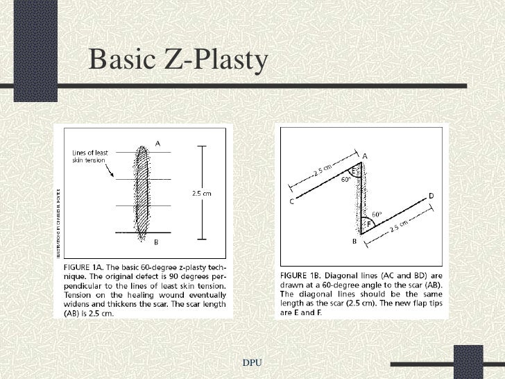 Z plasty