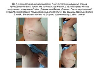 На 2-сутки больная активизирована. Аускультативно дыхание справа
проводится по всем полям. На контрольной Р-скопии легких справа легкое
расправлено, синусы свободны. Дренажи по Бюлау удалены. Послеоперационный
период без патологии. Пациентка самостоятельно, без одышки поднимается на
2 этаж. Больная выписана на 5-сутки после операции. Швы сняты.
 