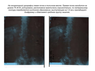 На экскреторной урографии левая почка в типичном месте. Правая почка находится на
уровне Th IX-XI, ротирована, расположена практически горизонтально, по латеральному
контуру определяется кистозное образование, выступающее на 1,5 см и пролабирует
диафрагму и сдавливает среднюю группу чашечек.
 