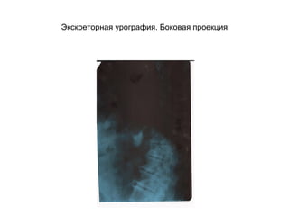 Экскреторная урография. Боковая проекция
 