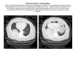 Компьютерная томография.
На КТ определяется релаксация правого купола диафрагмы. Правая почки пролабирует в грудную полость,
размеры правой почки 10,3*5,2 см, контуры ровные. Паренхима 1,8 см. , чашечки 0,6-0,8 см, лоханка 2,0*1,0
см. В области верхнего полюса правой почки жидкостное образование 4,3 см +6HU. В легочной ткани
патологической плотности не определяется. Проходимость трахеи и бронхов не нарушены. Синусы
свободны.
 