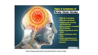 https://www.epainassist.com/brain/brain-stem-stroke
 