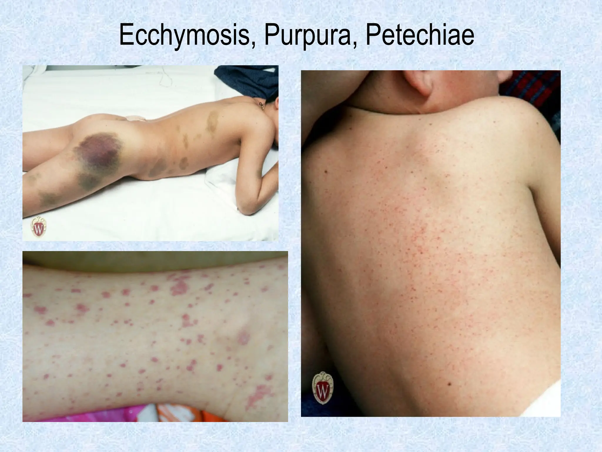 Ecchymosis, Purpura, Petechiae
 