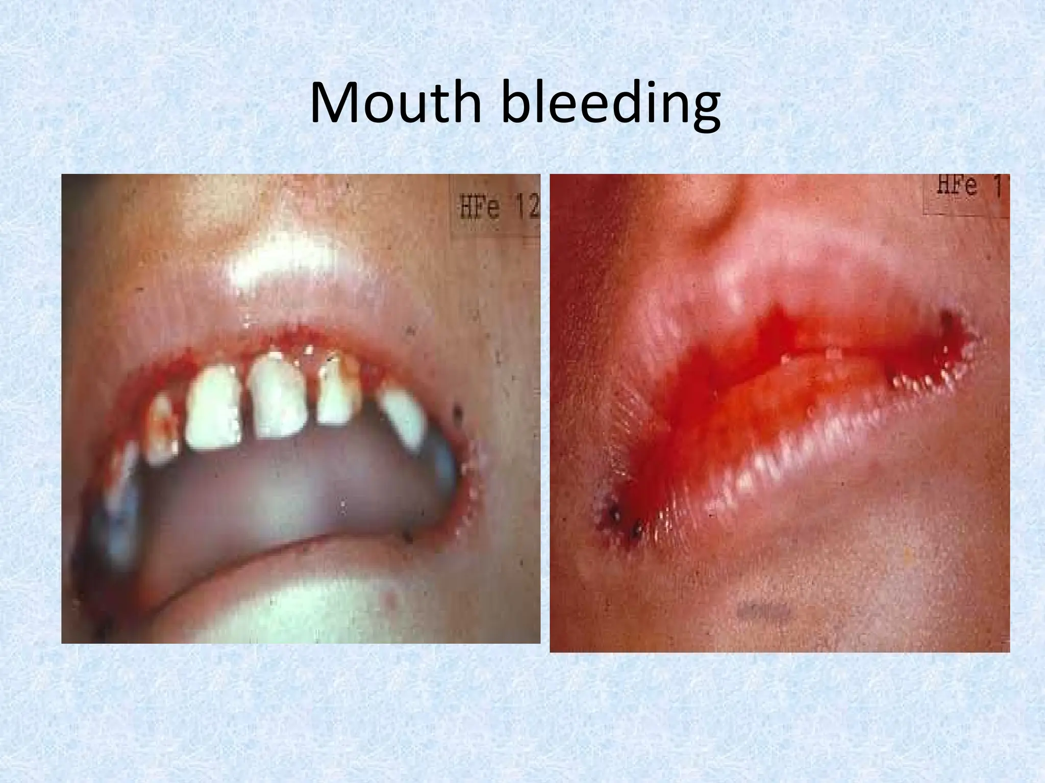 Mouth bleeding
 