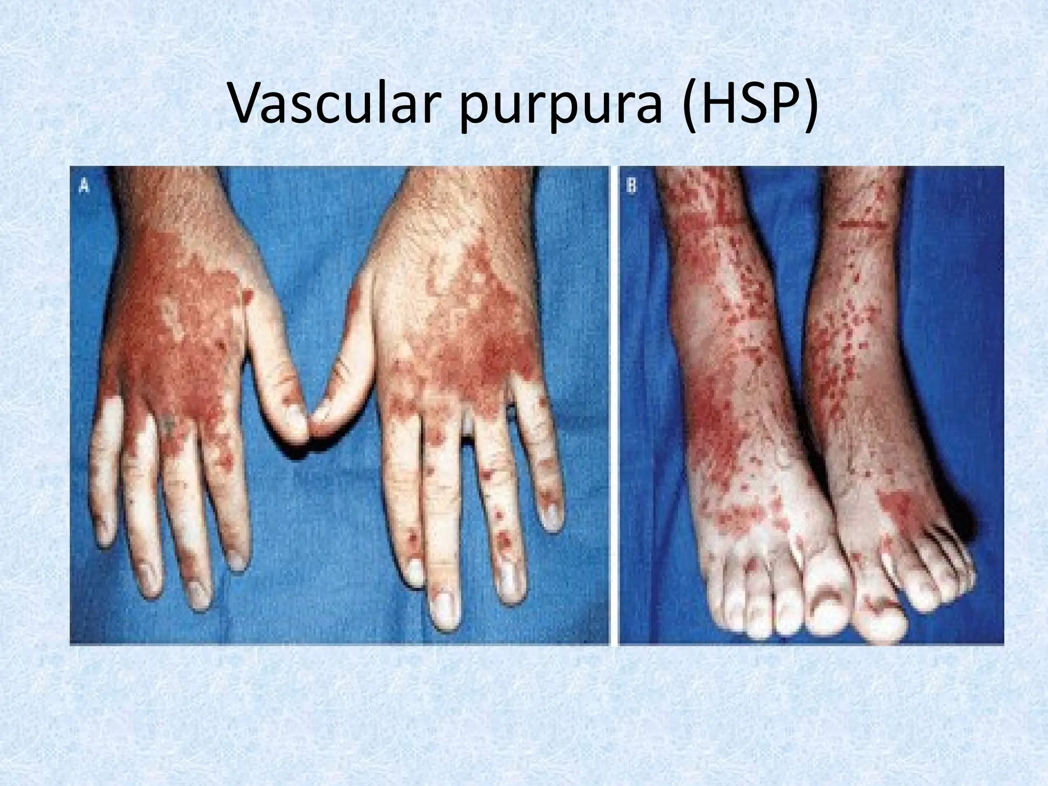 Vascular purpura (HSP)
 